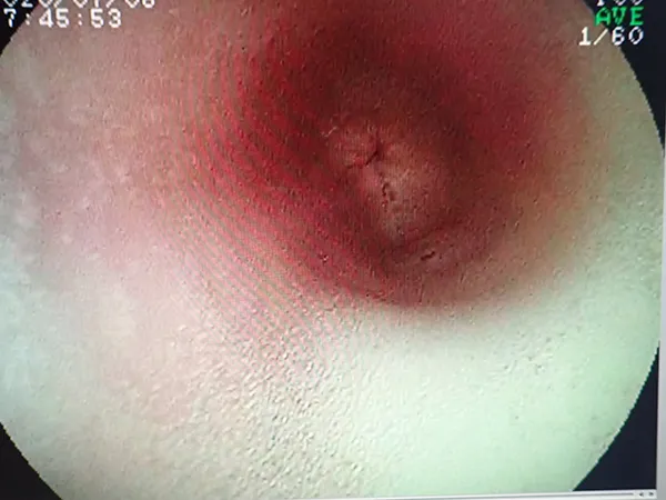 食道の観察